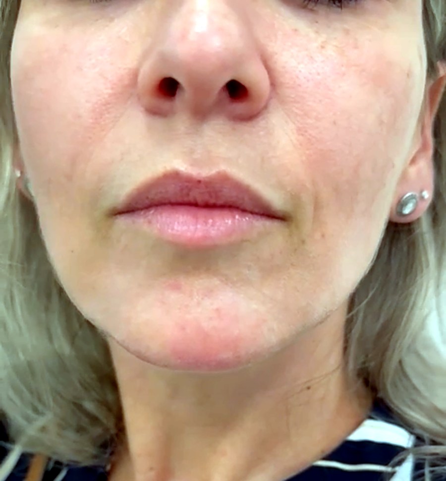 Antes: Relleno de labios con ácido hialurónico