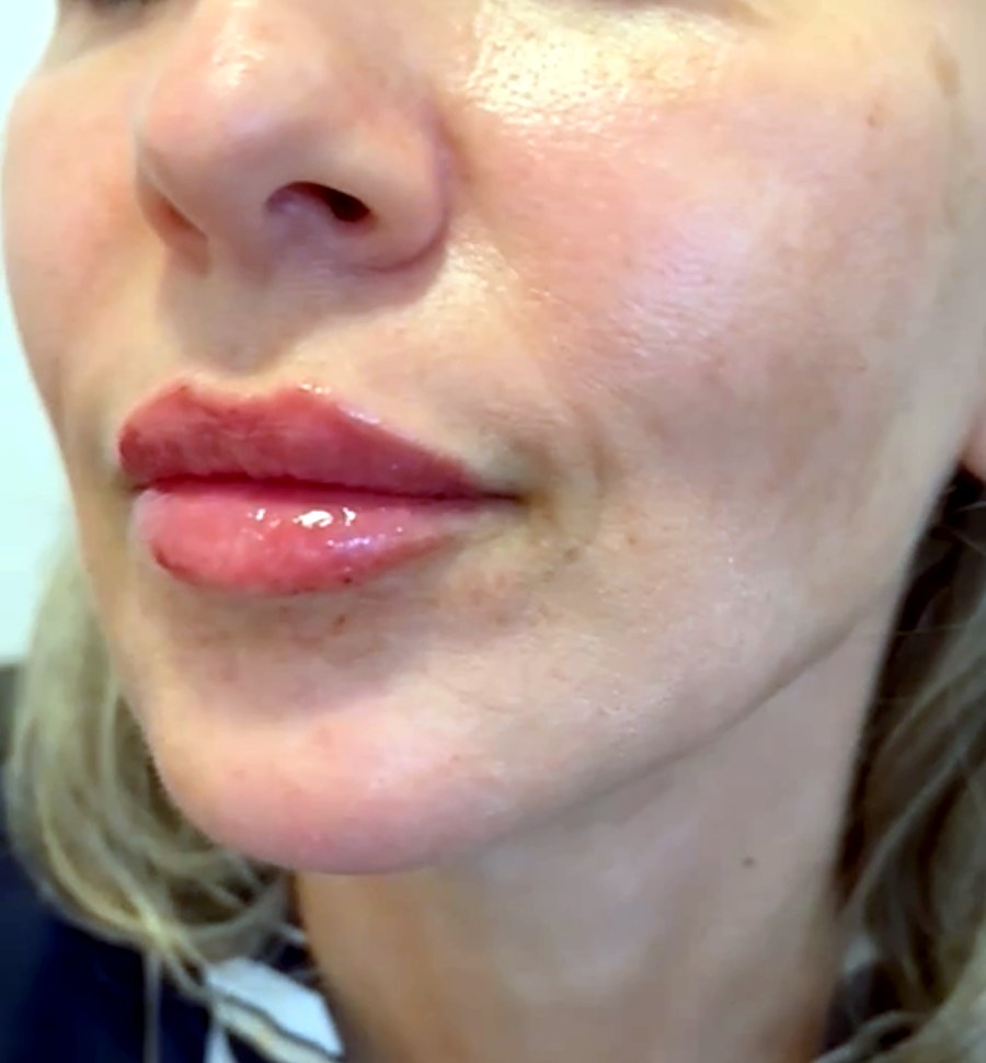 Después: Relleno de labios con ácido hialurónico