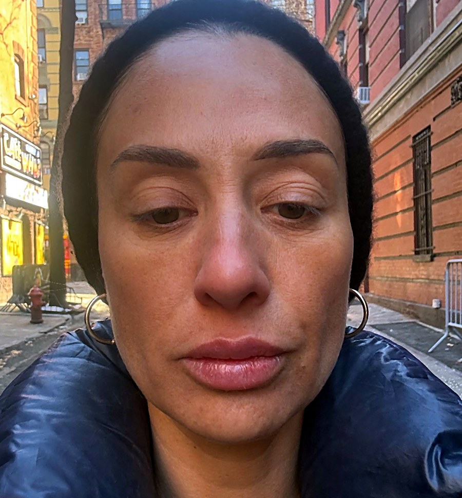 Después: Labios, perfilado y mentón