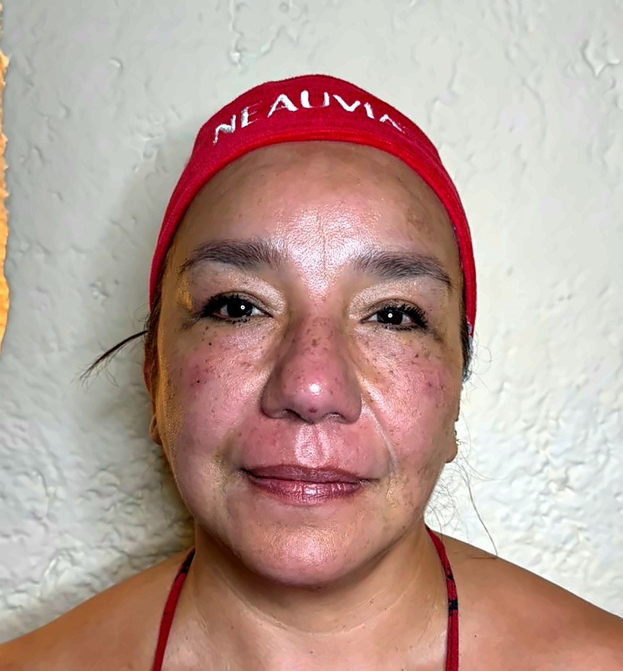 Después: Skinbooster y levantamiento del tercio medio con ácido hialurónico